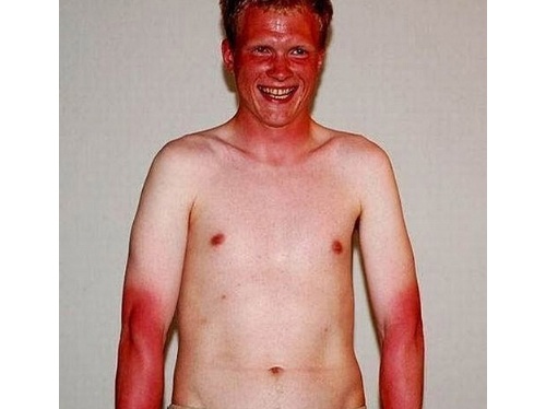 bad_sunburn-t2